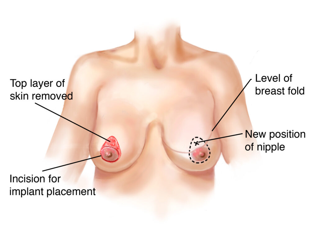 https://www.drycosmetoplastic.com/wp-content/uploads/2021/08/nipple-reconstruction-surgery1-1024x748.jpg